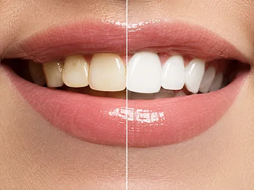 Blanqueamiento dental